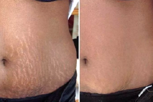 Correção e Camuflagem (Correction)